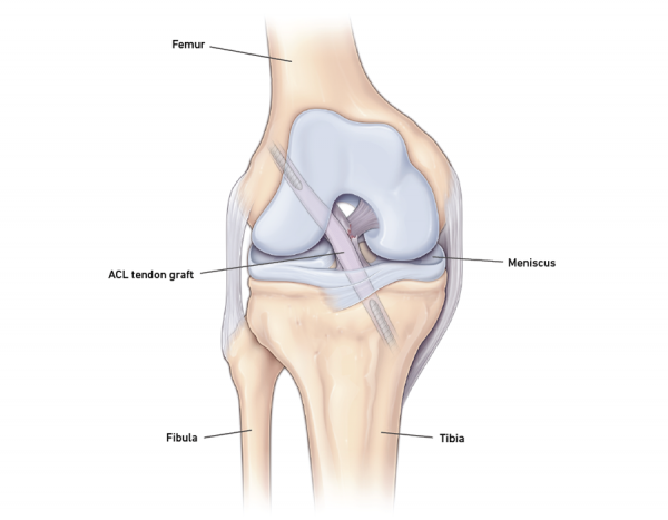 ACL RECONSTRUCTION