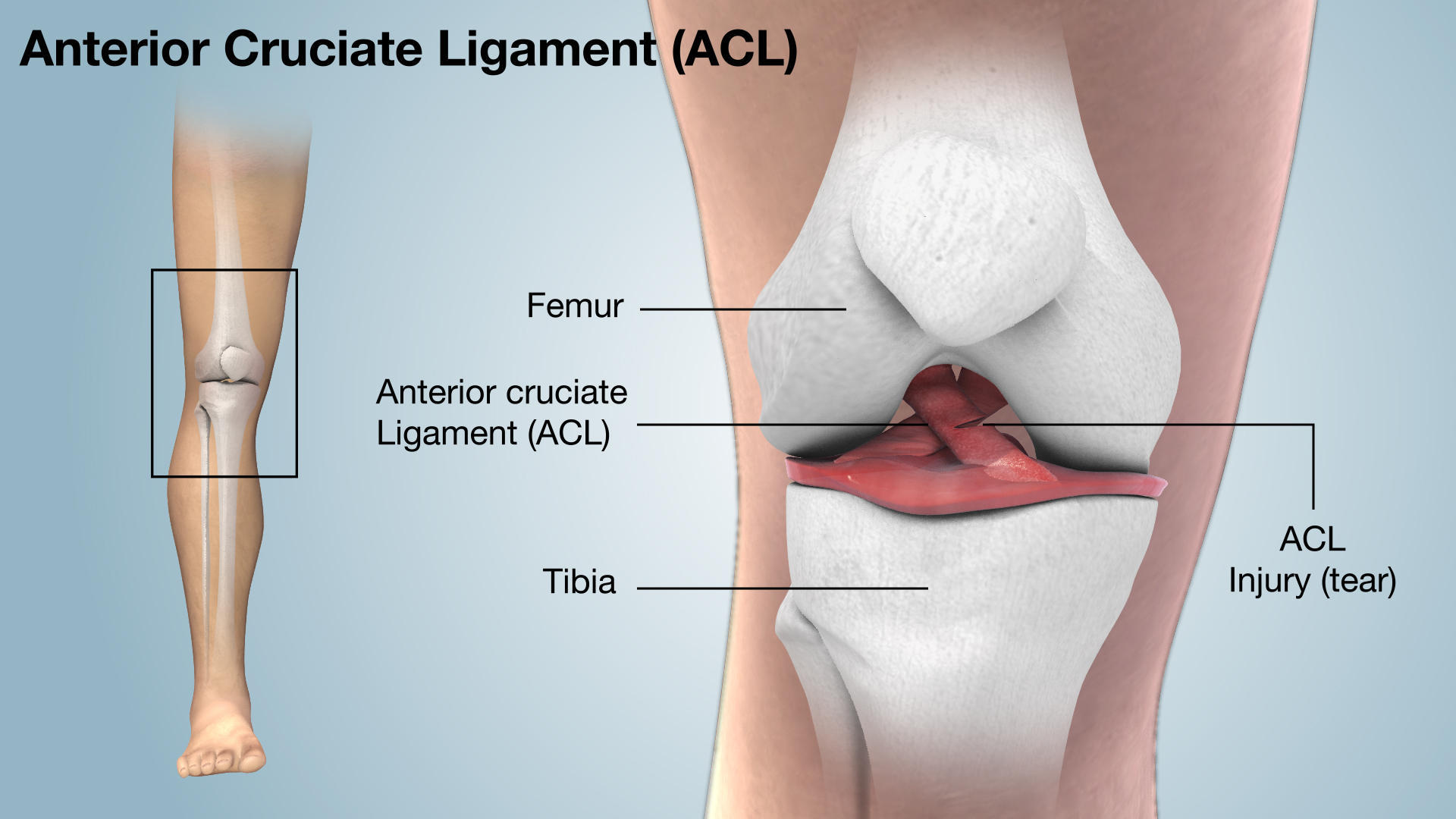 ACL Tear