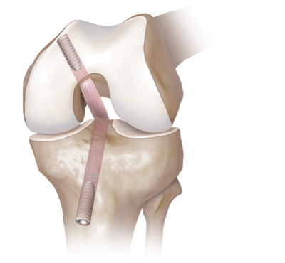 PCL Reconstruction