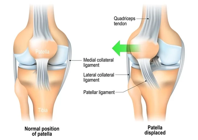 Patellar dislocation