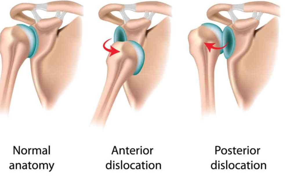 Dislocated Shoulder