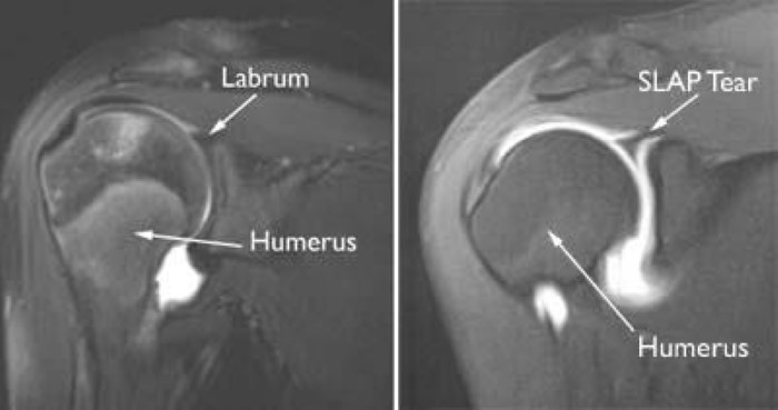 SLAP Tear