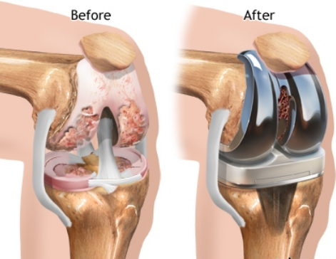 Fast-Track  Knee Arthroplasty