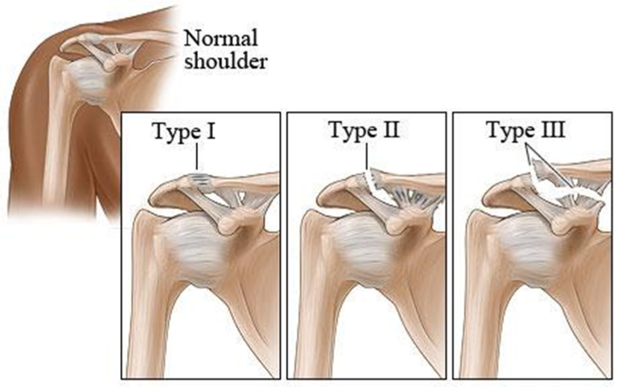 AC JOINT DISLOCATION