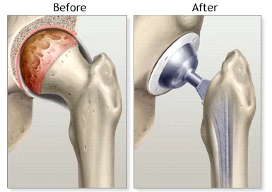 Fast-track Hip Arthroplasty