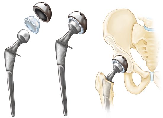 Total Hip Replacement Surgery