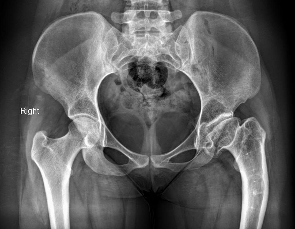 Avascular Necrosis of the Hip