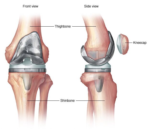 Total Knee Replacement Surgery