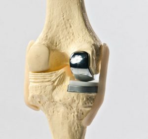 Unicondylar Knee Replacement