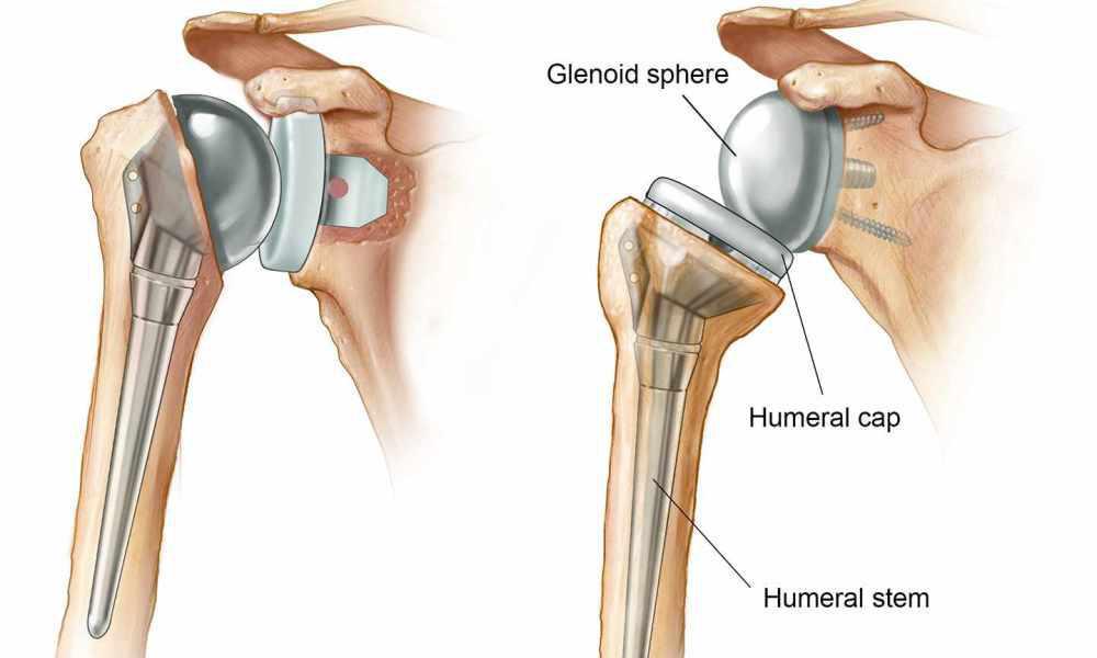 Shoulder Replacement surgery