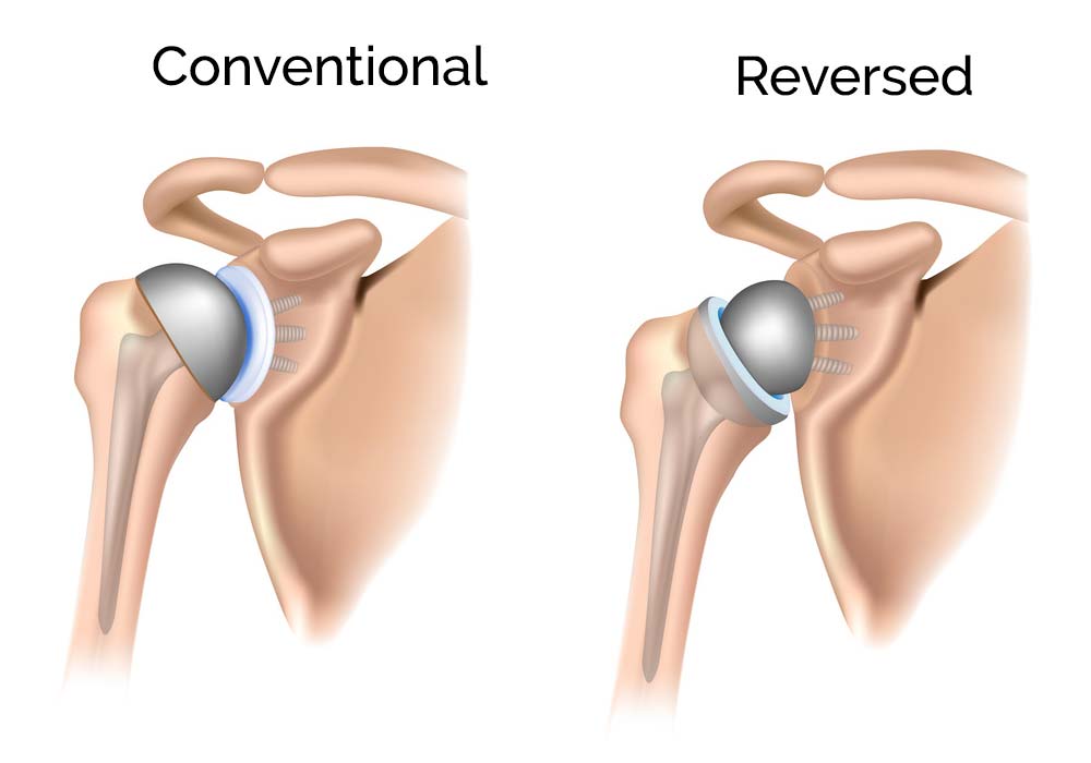 Reverse Shoulder Replacement